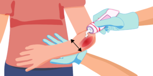 Подробнее о статье Профилактика пролежней: современные методы