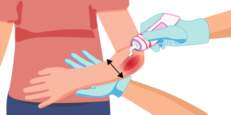 Профилактика пролежней: современные методы